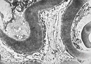 M,22y. | type II membranoproliferative glomerulonephritis M,22y. | type II membranoproliferative glomerulonephritis